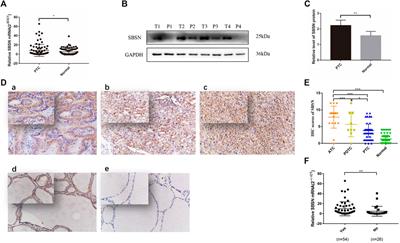 Role of Suprabasin in the Dedifferentiation of Follicular Epithelial Cell-Derived Thyroid Cancer and Identification of Related Immune Markers